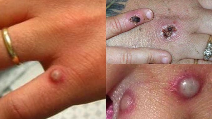 Eerste geval apenpokkenvirus in Nederland; Spoedvergadering WHO
