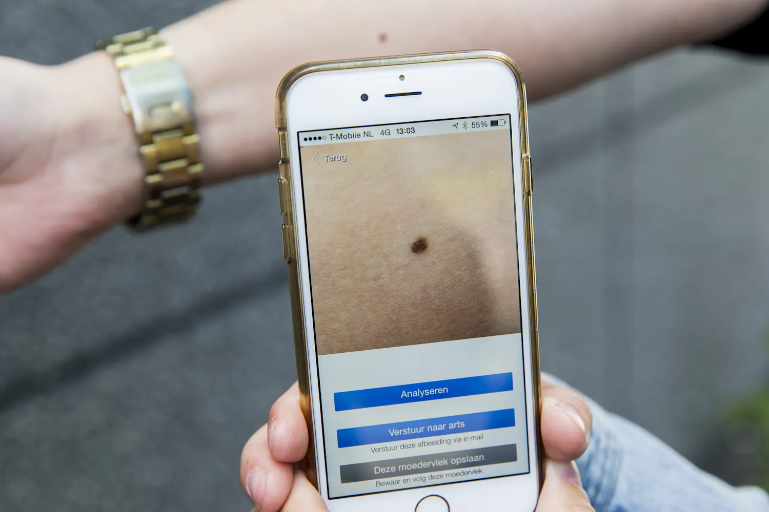 Onderzoek: AI kan risico op melanoom voorspellen voor diagnose