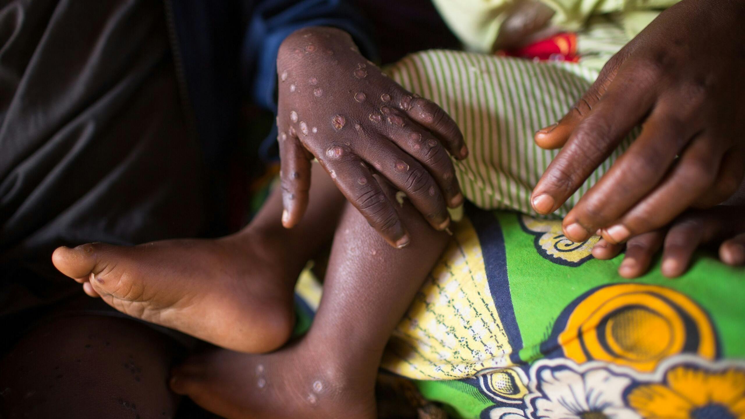 Uitbraak van monkeypox (apenpokken) in Bomgongolo, Democratische Republiek Congo.